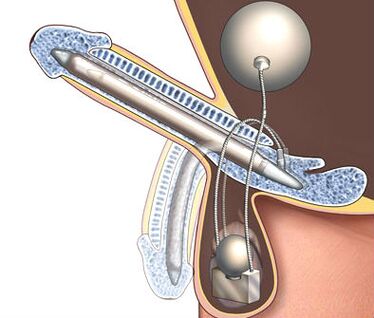 penis prosthesis aron mapadako kini